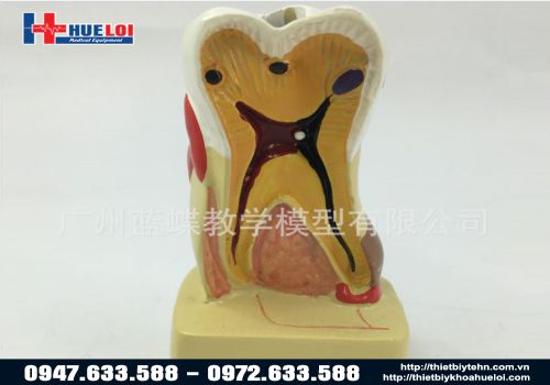 Mô hình răng bệnh lý