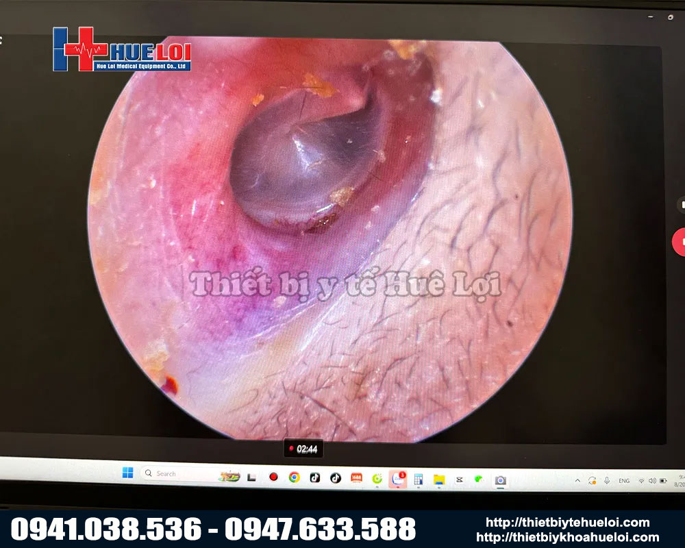 Chất lượng hình ảnh của máy nội soi TMH mini