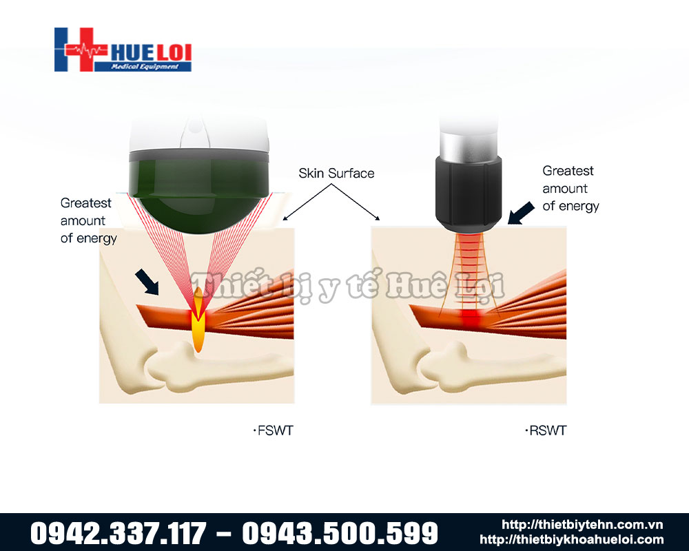 Sự khác biệt trong quá trình điều trị giữa 2 loại sóng này