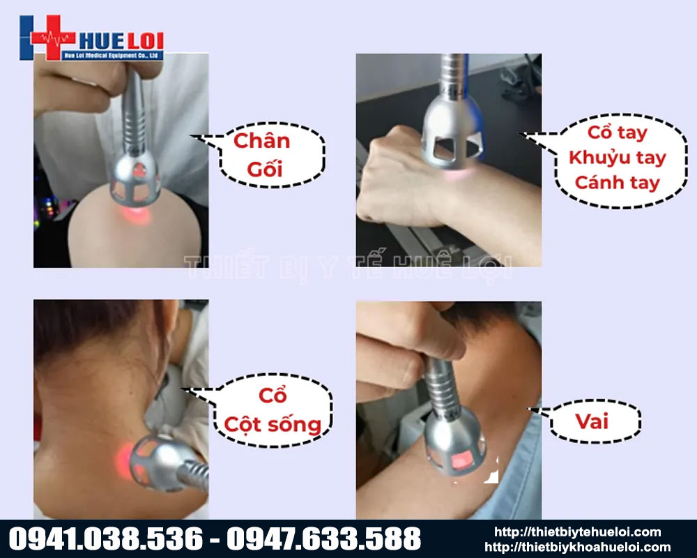 Các vùng điều trị của máy laser EC30 đơn bước sóng
