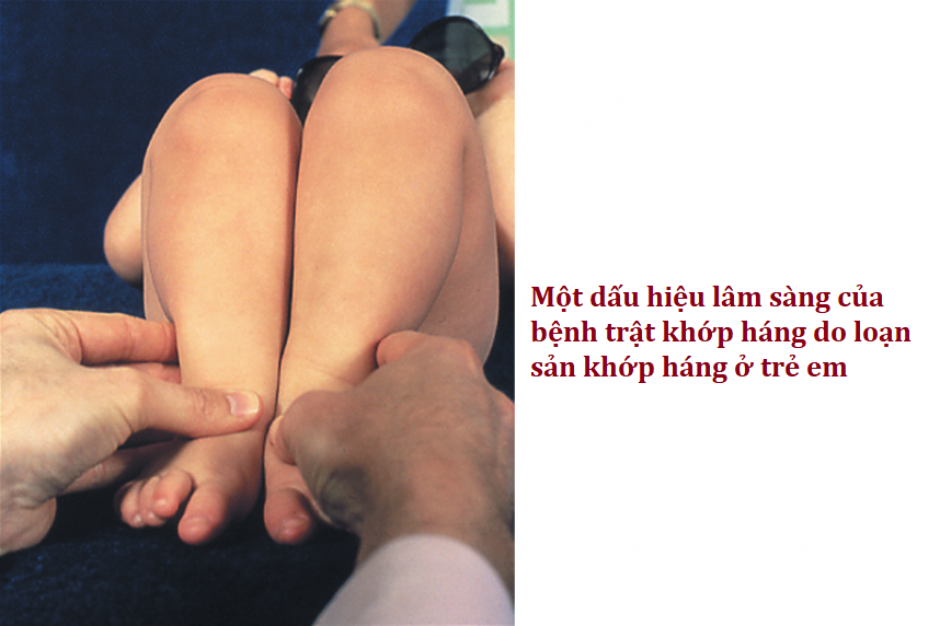 loạn sản khớp háng trẻ em