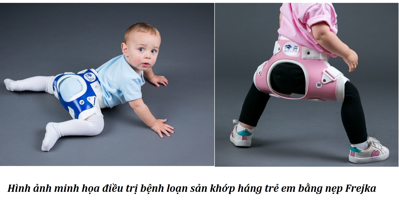 nẹp điều trị loạn sản khớp háng trẻ sơ sinh