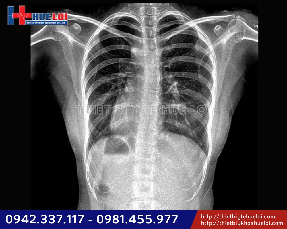 chất lượng hình ảnh máy x-quang cố đinh Yolong